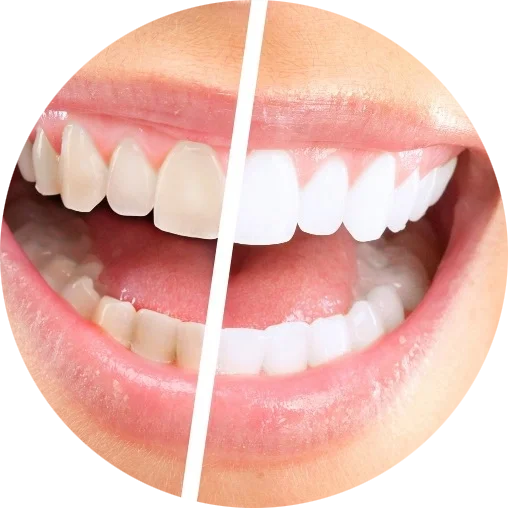 Баннер Отбеливание зубов Баннер Отбеливание зубов